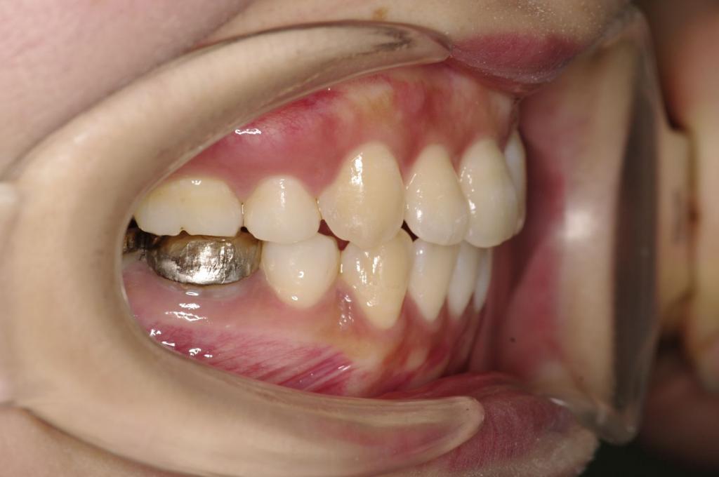 前歯、出っ歯・開咬の矯正治療後口内写真NO.1027