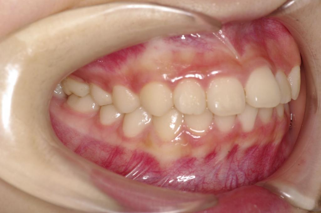 前歯、出っ歯・開咬の矯正治療前口内写真NO.1028
