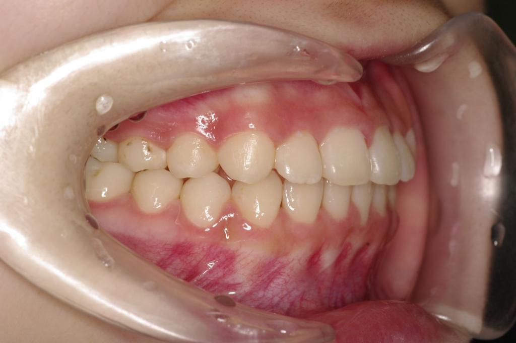 前歯、出っ歯・開咬の矯正治療後口内写真NO.1028