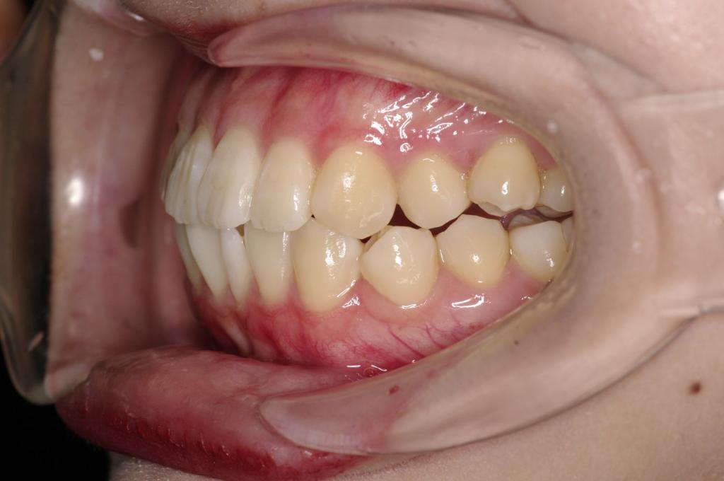 前歯、出っ歯・開咬の矯正治療前口内写真NO.1029