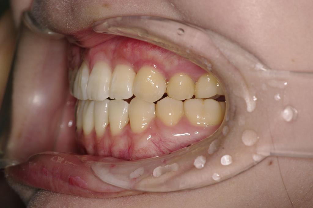 前歯、出っ歯・開咬の矯正治療後口内写真NO.1029