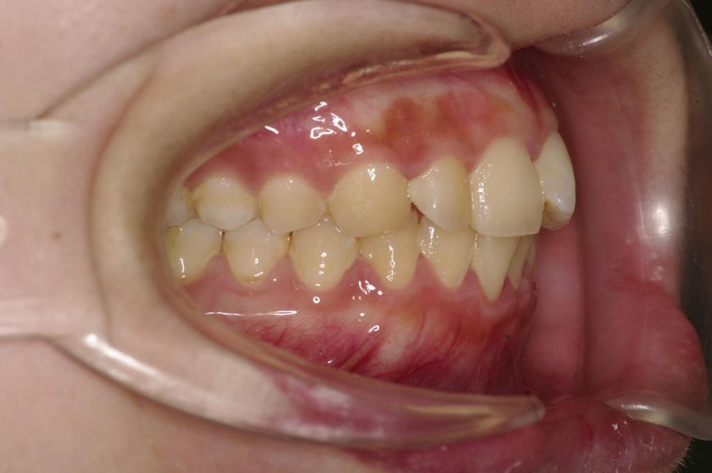 前歯、出っ歯・開咬の矯正治療前口内写真NO.1037