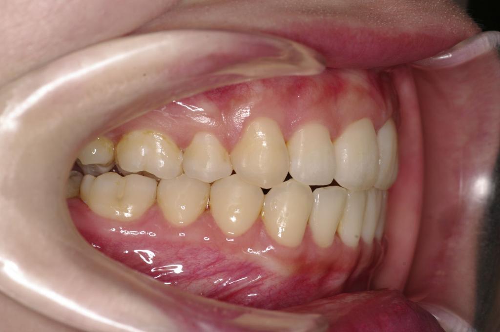 前歯、出っ歯・開咬の矯正治療後口内写真NO.1085
