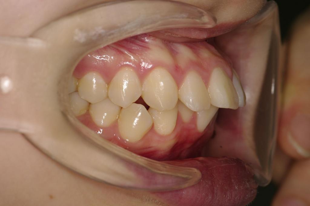 前歯、出っ歯・開咬の矯正治療前口内写真NO.1086