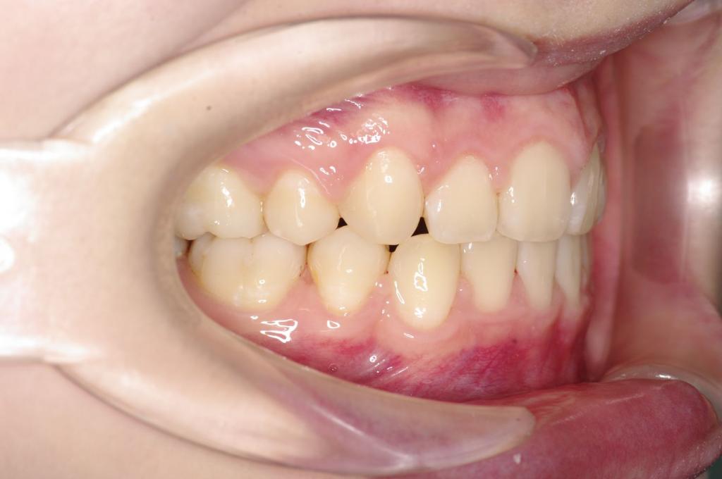 前歯、出っ歯・開咬の矯正治療後口内写真NO.1086