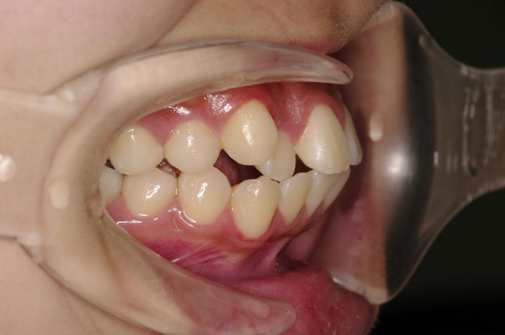 前歯、出っ歯・開咬の矯正治療前口内写真NO.1087