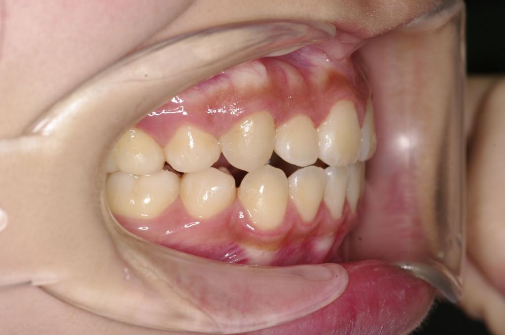 前歯、出っ歯・開咬の矯正治療後口内写真NO.1087