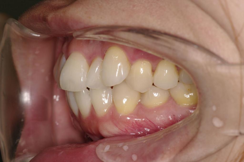 前歯、出っ歯・開咬の矯正治療前口内写真NO.1088