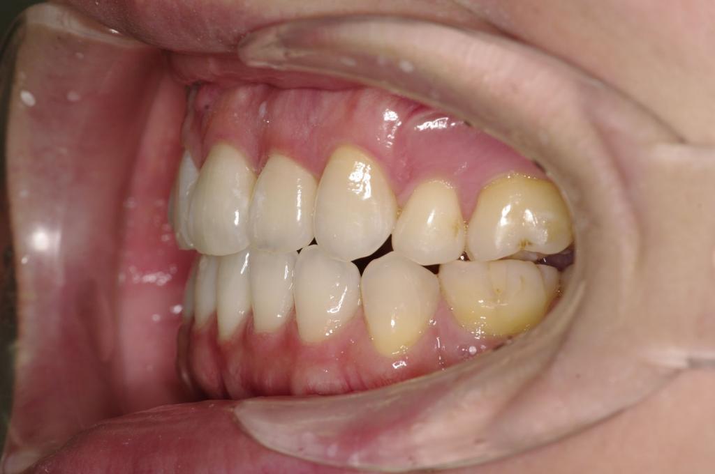 前歯、出っ歯・開咬の矯正治療後口内写真NO.1088