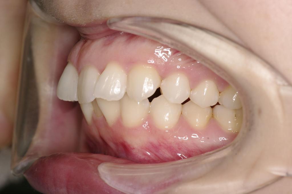 前歯、出っ歯・開咬の矯正治療前口内写真NO.1089