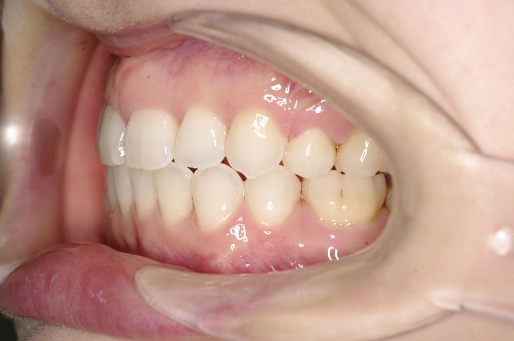 前歯、出っ歯・開咬の矯正治療後口内写真NO.1089