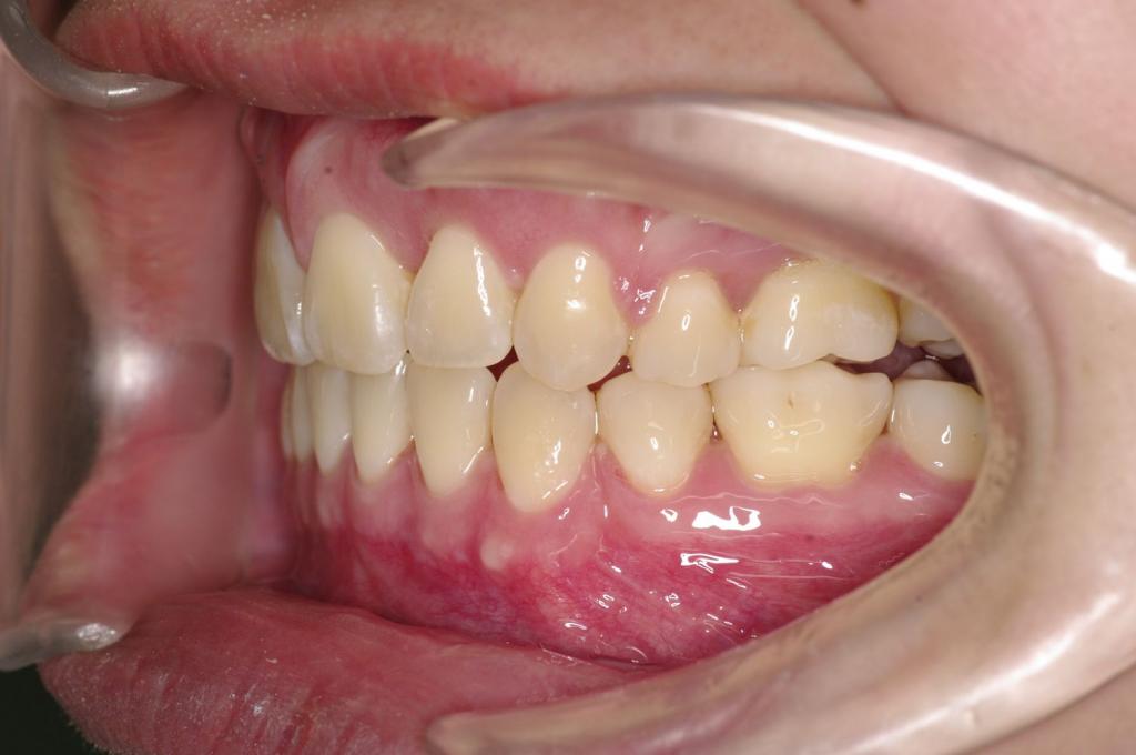 前歯、出っ歯・開咬の矯正治療後口内写真NO.1091