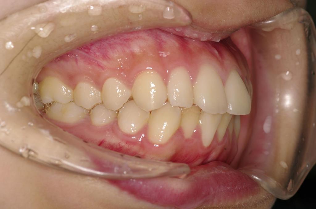 前歯、出っ歯・開咬の矯正治療前口内写真NO.1092