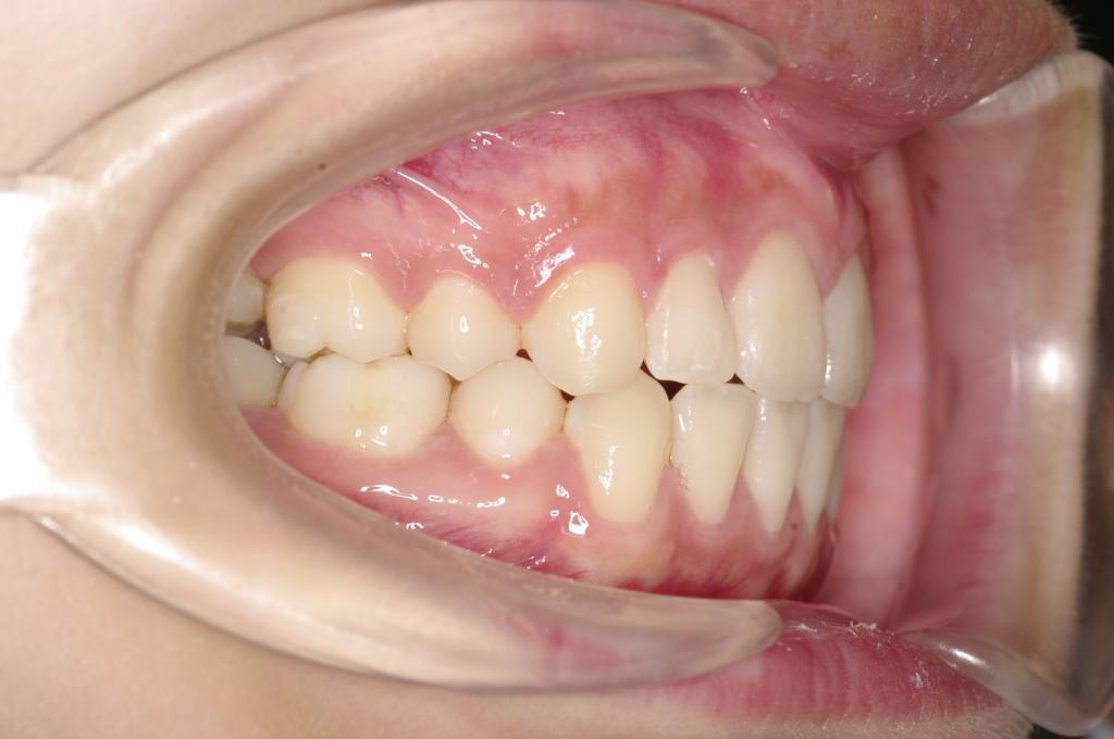 前歯、出っ歯・開咬の矯正治療後口内写真NO.1092