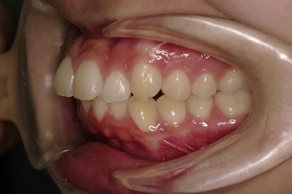 前歯、出っ歯・開咬の矯正治療前口内写真NO.1093