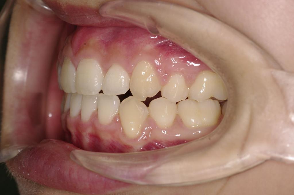 前歯、出っ歯・開咬の矯正治療後口内写真NO.1093