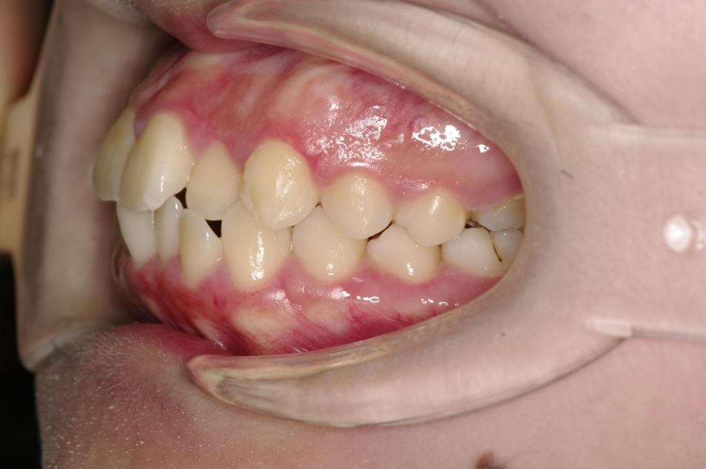 前歯、出っ歯・開咬の矯正治療前口内写真NO.1094