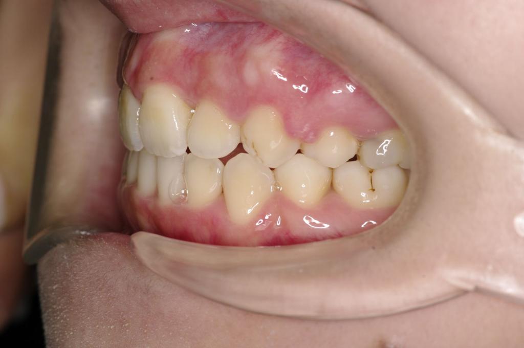 前歯、出っ歯・開咬の矯正治療後口内写真NO.1094