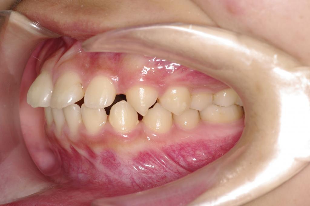 前歯、出っ歯・開咬の矯正治療前口内写真NO.1095