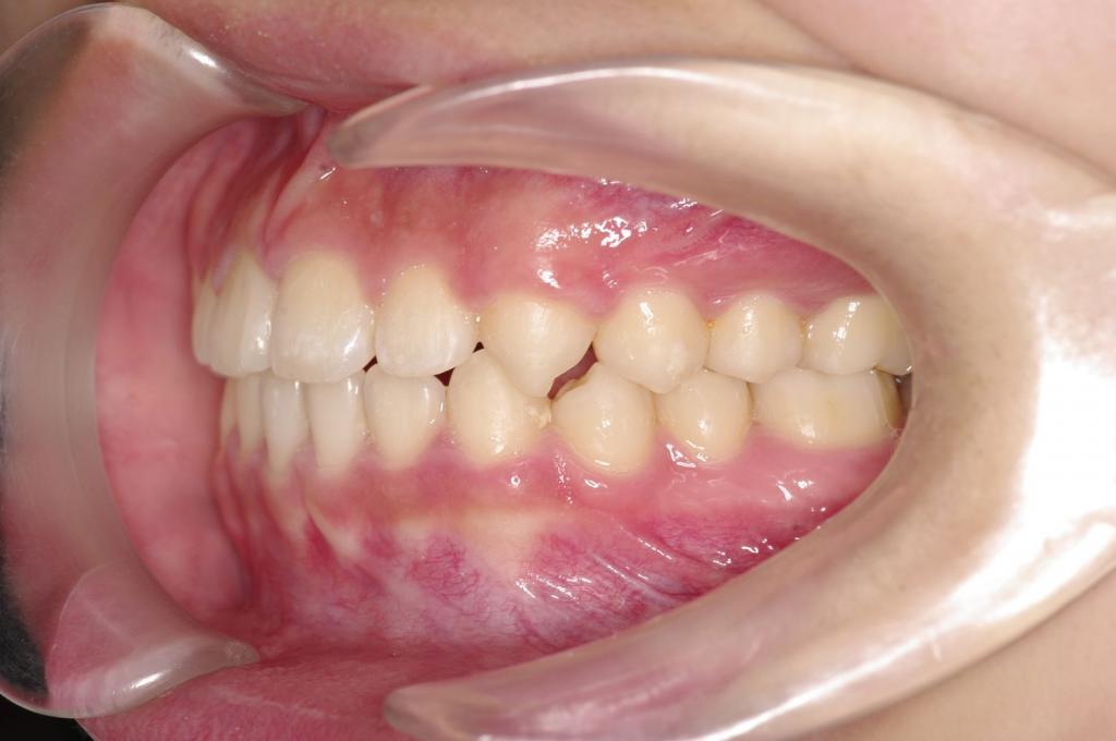 前歯、出っ歯・開咬の矯正治療後口内写真NO.1095