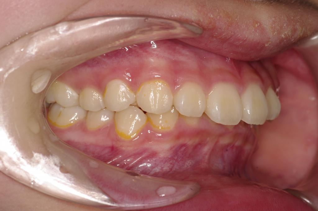 前歯、出っ歯・開咬の矯正治療前口内写真NO.1096