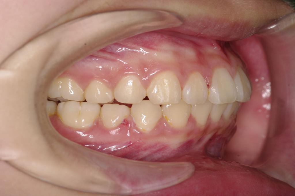 前歯、出っ歯・開咬の矯正治療後口内写真NO.1096