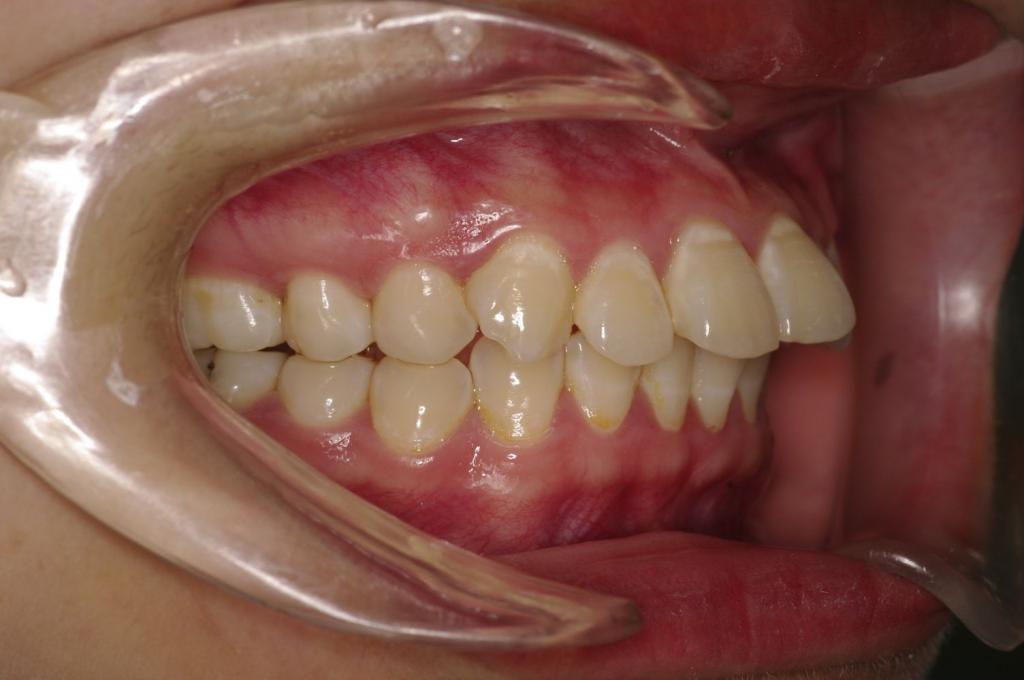 前歯、出っ歯・開咬の矯正治療前口内写真NO.1097