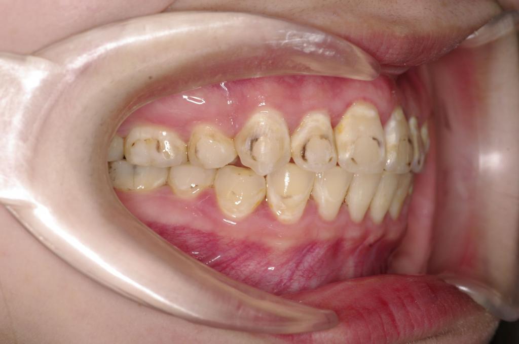 前歯、出っ歯・開咬の矯正治療後口内写真NO.1097