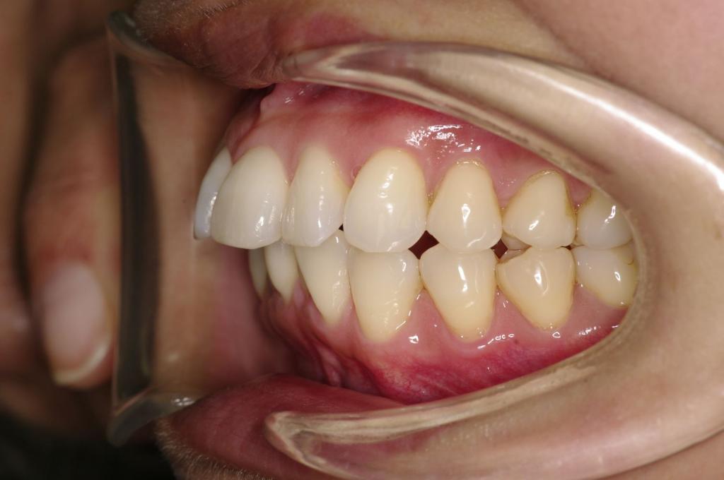 前歯、出っ歯・開咬の矯正治療前口内写真NO.1098