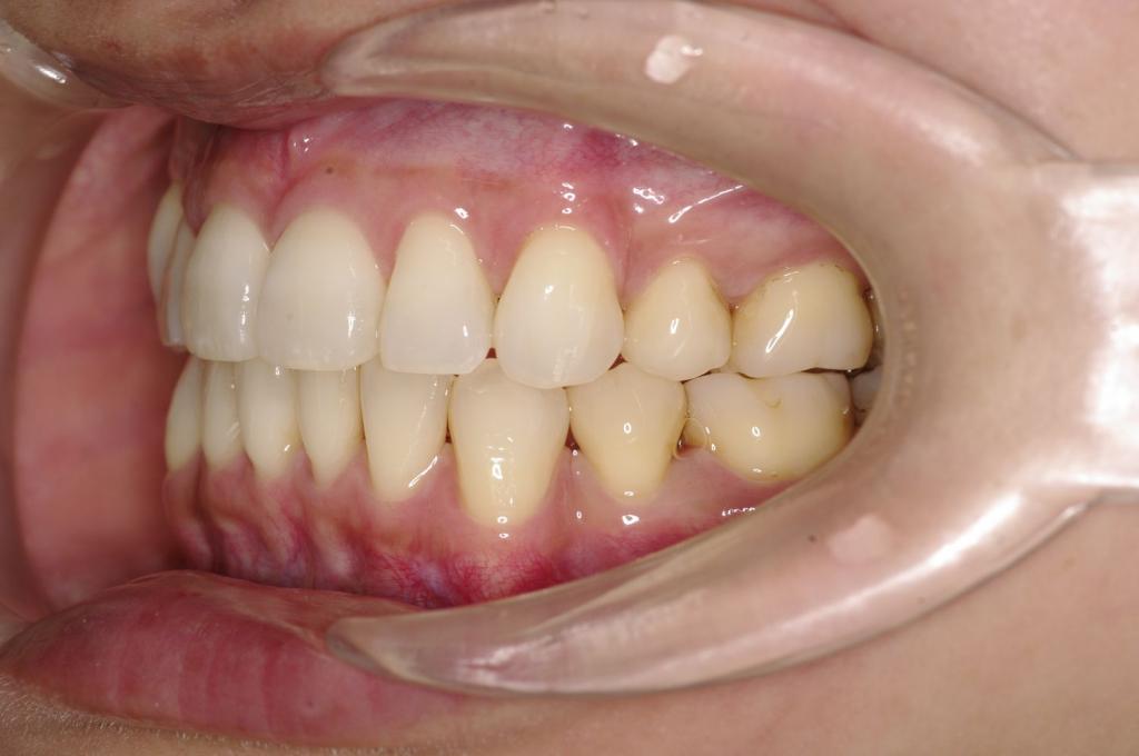 前歯、出っ歯・開咬の矯正治療後口内写真NO.1098