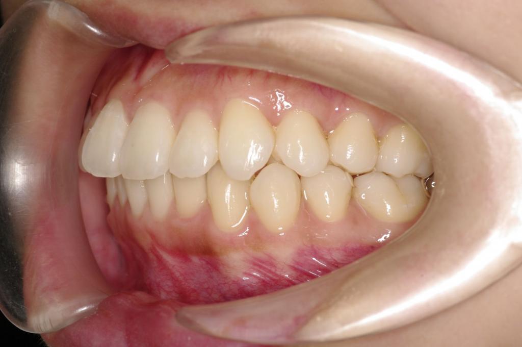 前歯、出っ歯・開咬の矯正治療前口内写真NO.1099