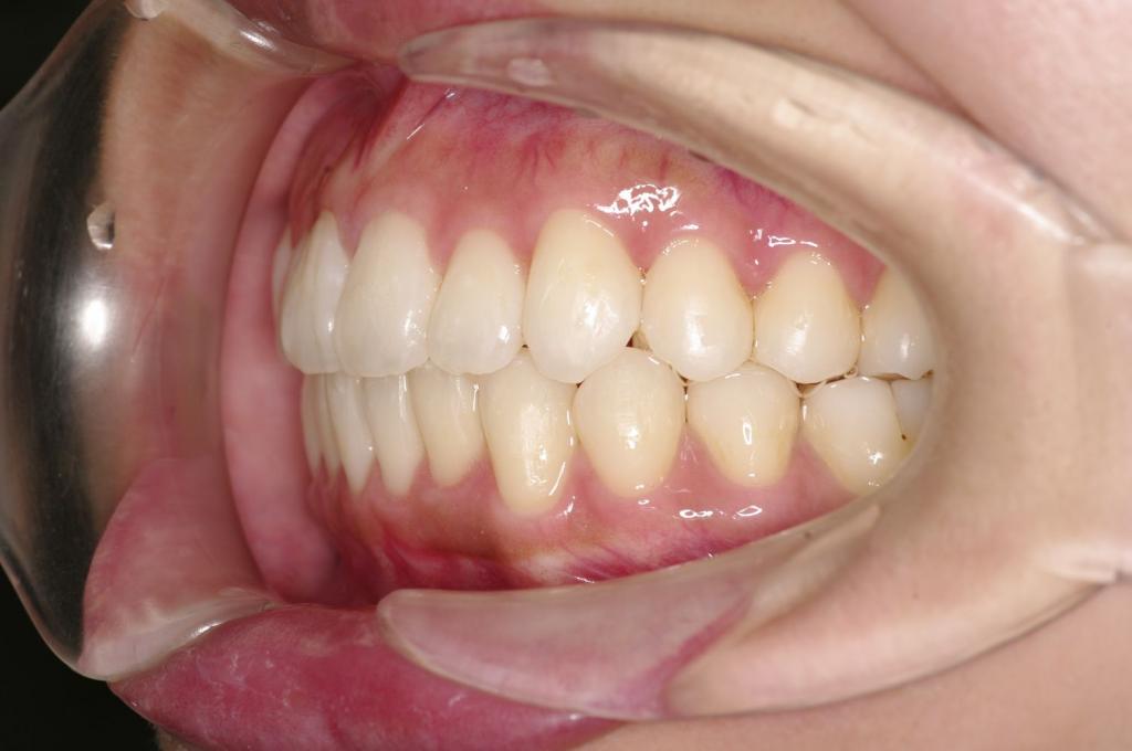 前歯、出っ歯・開咬の矯正治療後口内写真NO.1099