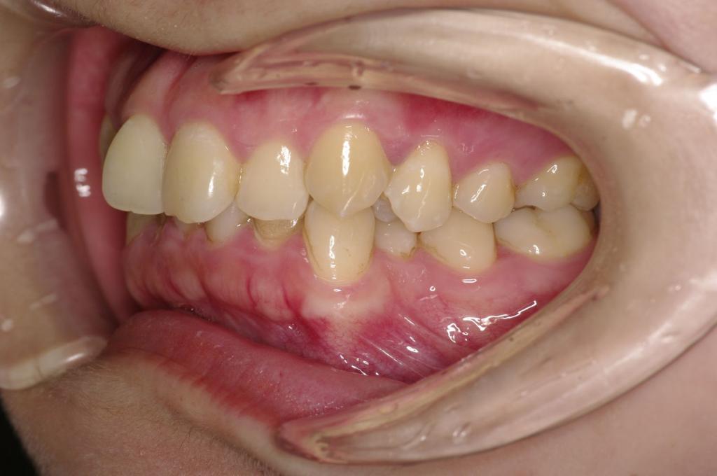 前歯、出っ歯・開咬の矯正治療前口内写真NO.1100