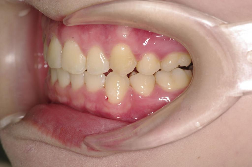 前歯、出っ歯・開咬の矯正治療後口内写真NO.1100