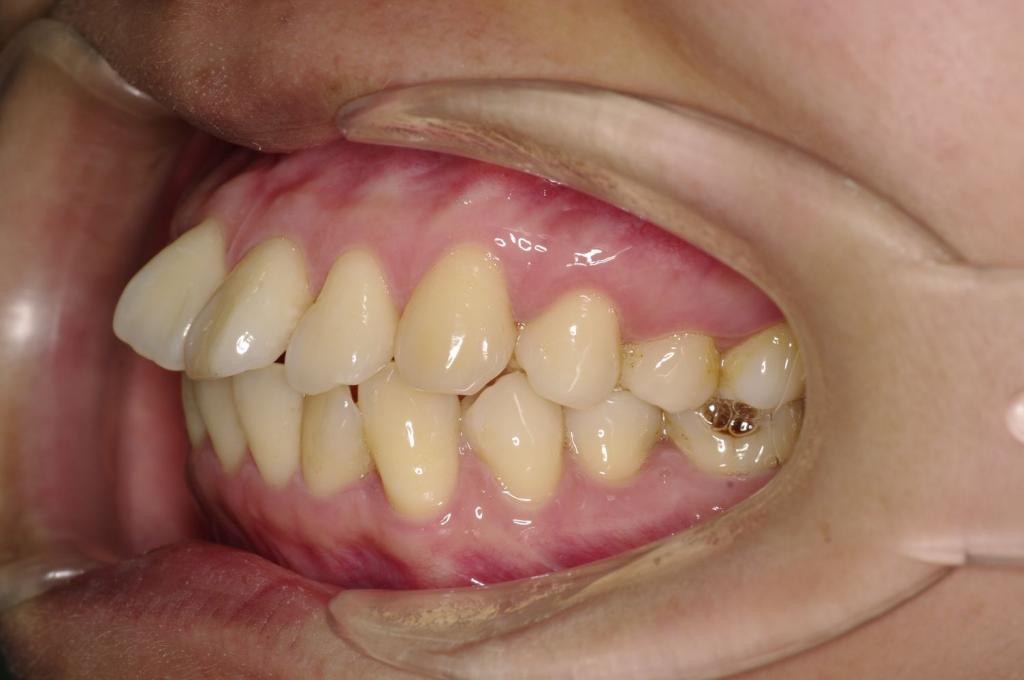 前歯、出っ歯・開咬の矯正治療前口内写真NO.1101