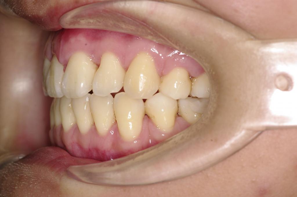 前歯、出っ歯・開咬の矯正治療後口内写真NO.1101
