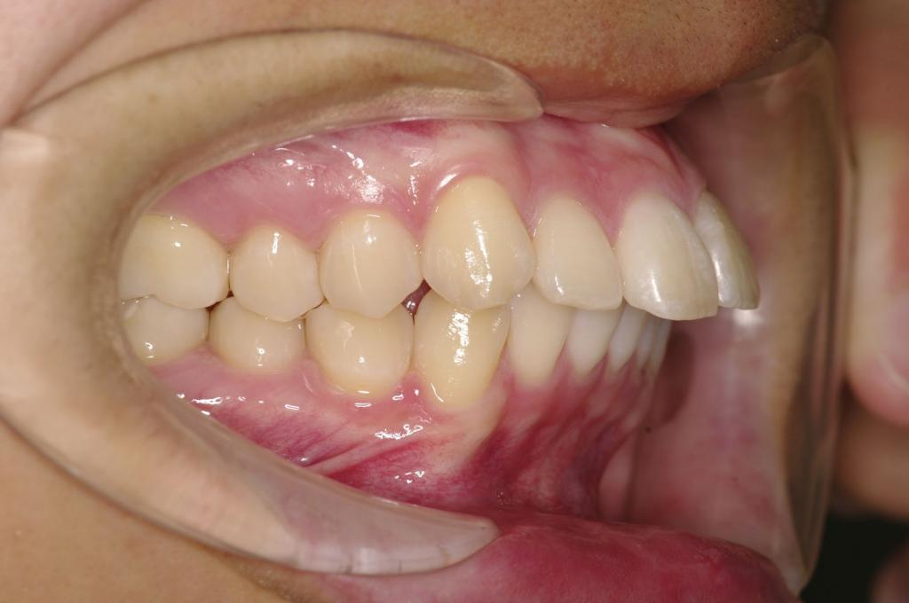 前歯、出っ歯・開咬の矯正治療前口内写真NO.1102