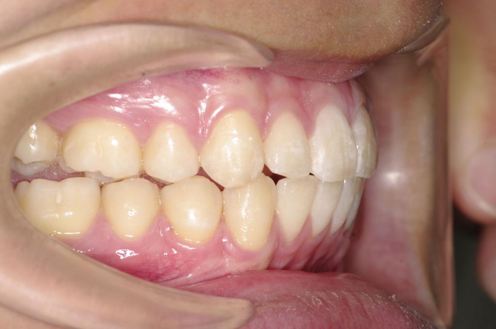 前歯、出っ歯・開咬の矯正治療後口内写真NO.1102