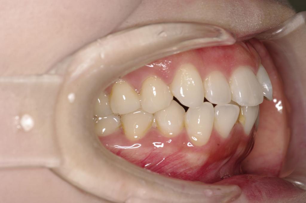 前歯、出っ歯・開咬の矯正治療前口内写真NO.1103