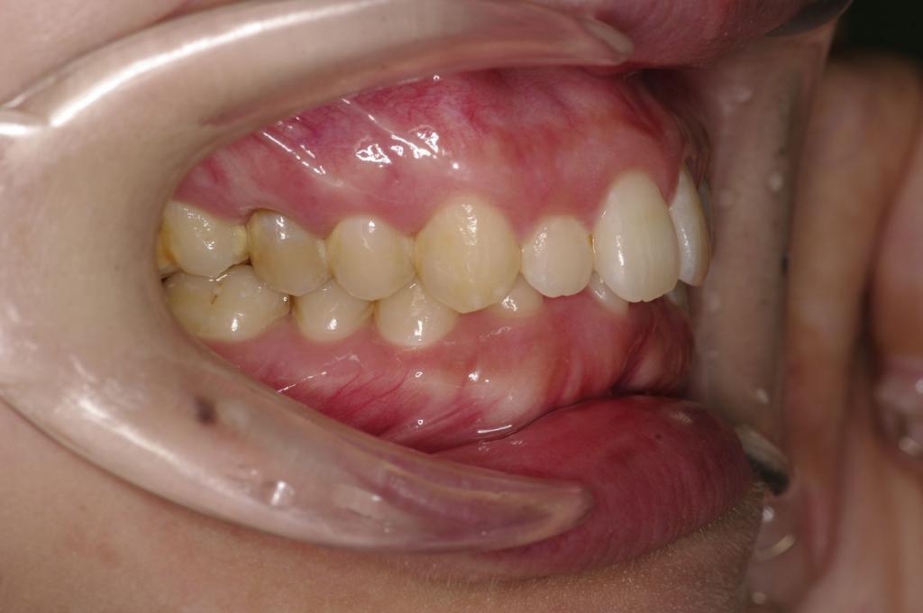 前歯、出っ歯・開咬の矯正治療前口内写真NO.1104