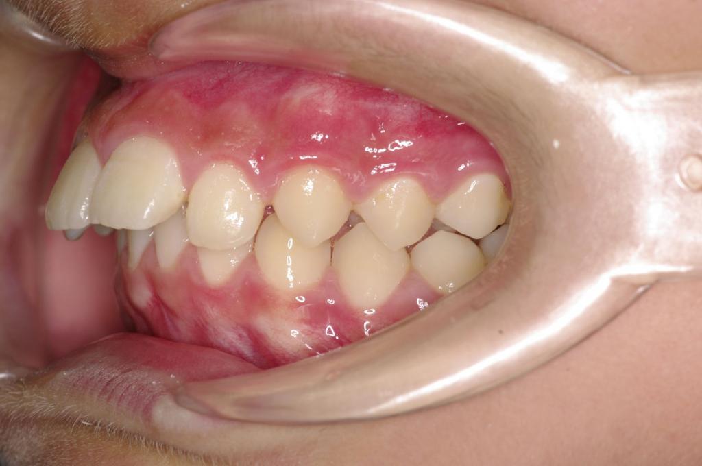 前歯、出っ歯・開咬の矯正治療前口内写真NO.1105