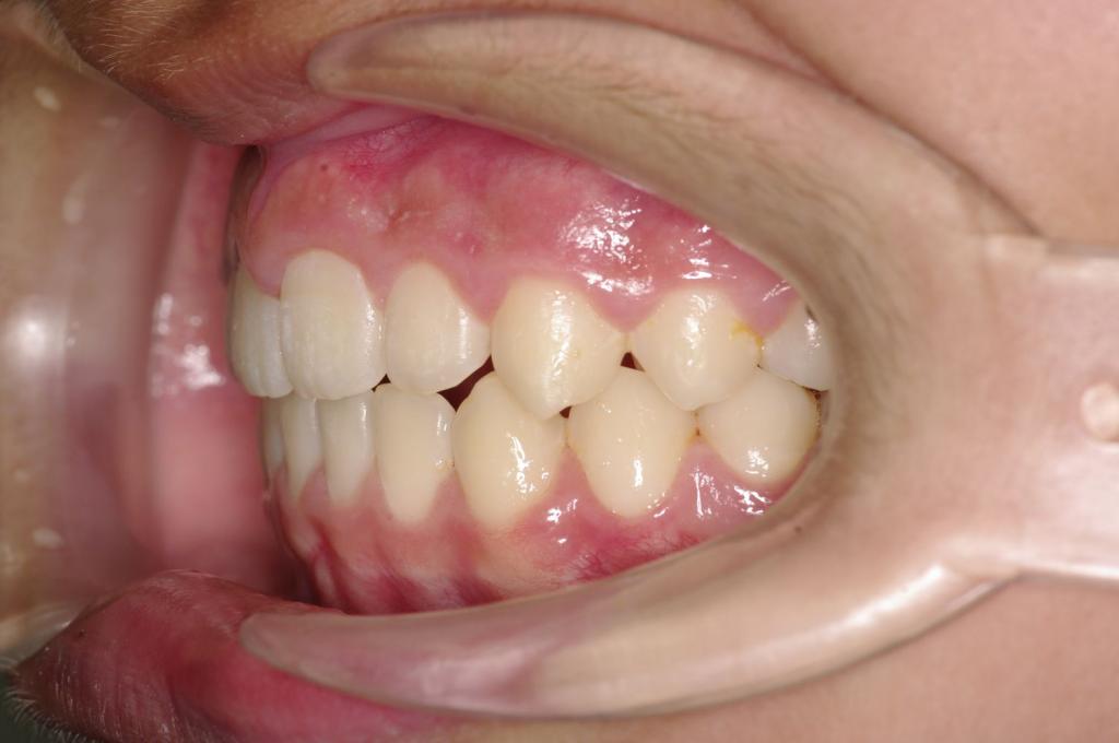 前歯、出っ歯・開咬の矯正治療後口内写真NO.1105