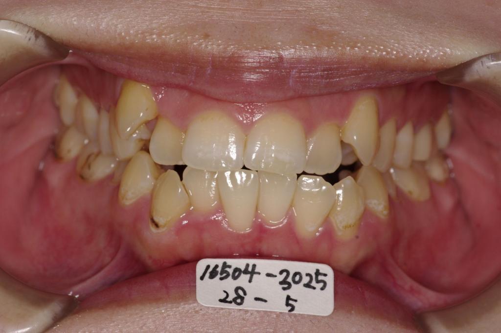 前歯、出っ歯・開咬の矯正治療前口内写真NO.1106