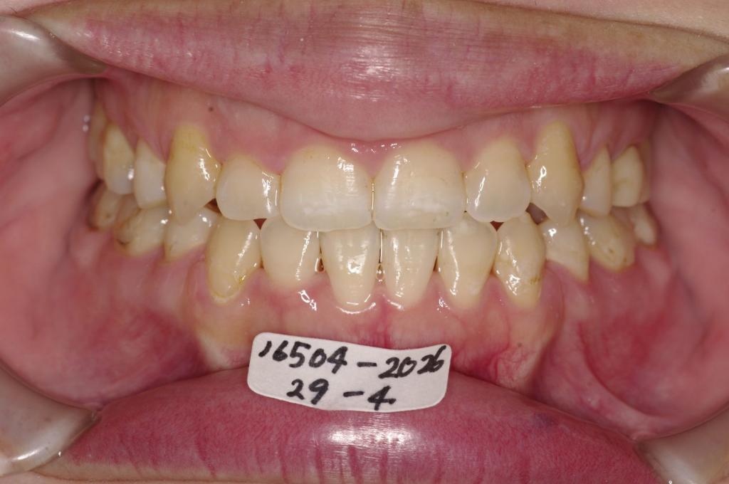 前歯、出っ歯・開咬の矯正治療後口内写真NO.1106
