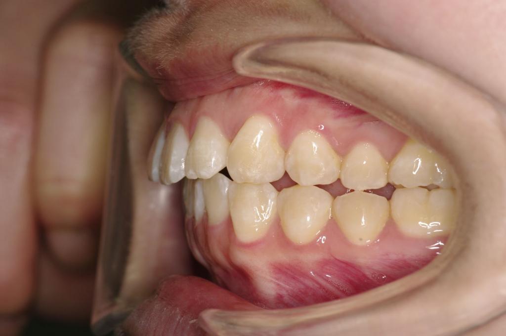 前歯、出っ歯・開咬の矯正治療前口内写真NO.1107