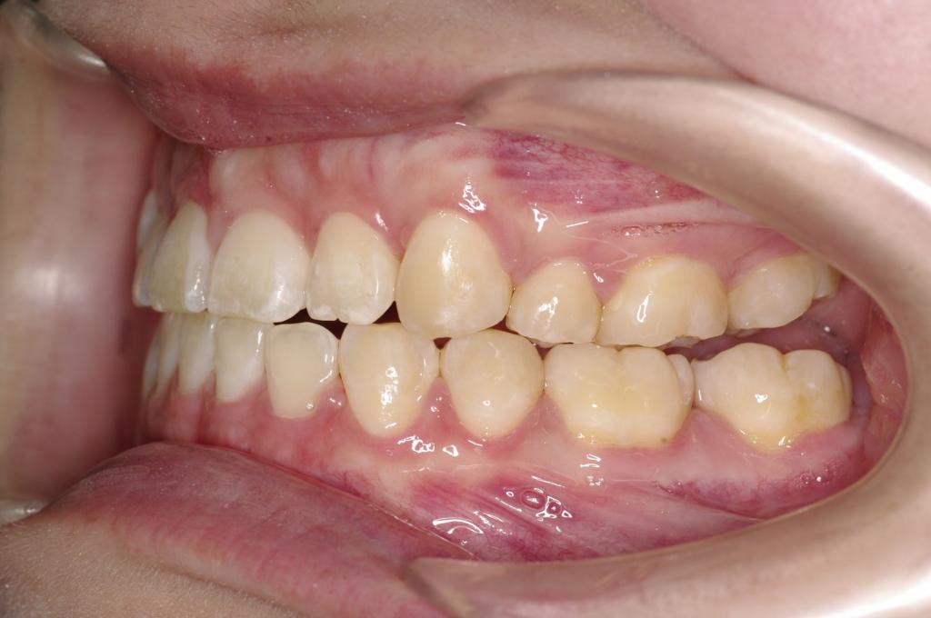 前歯、出っ歯・開咬の矯正治療後口内写真NO.1107