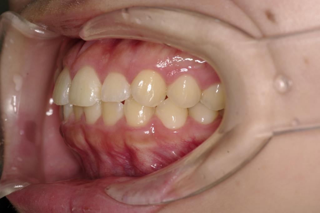前歯、出っ歯・開咬の矯正治療前口内写真NO.1108