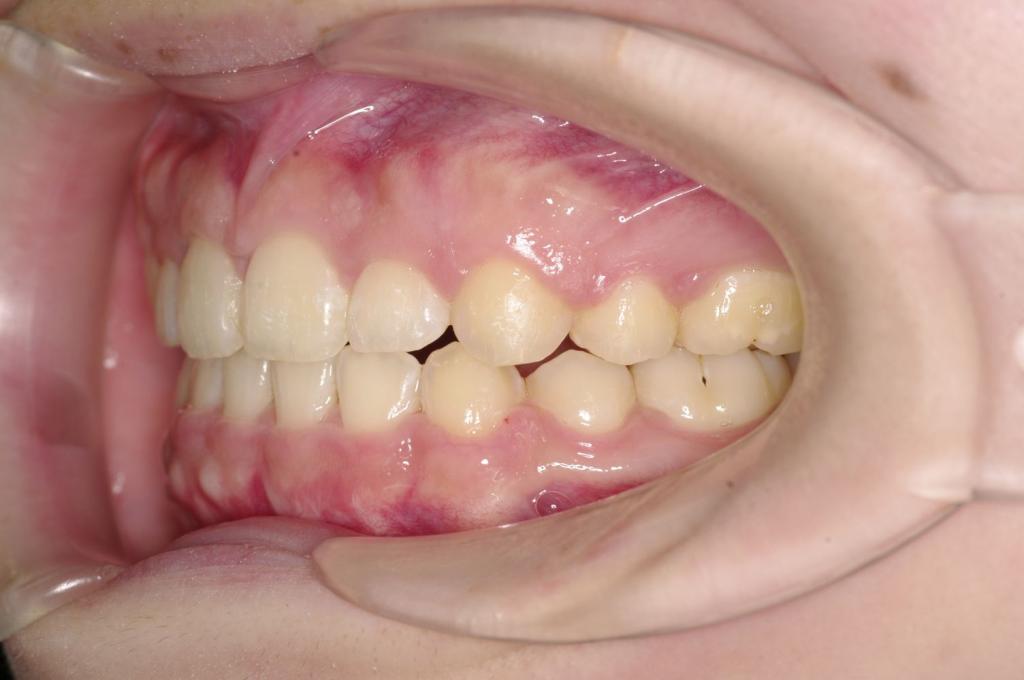 前歯、出っ歯・開咬の矯正治療後口内写真NO.1108