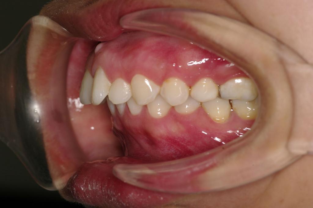 前歯、出っ歯・開咬の矯正治療前口内写真NO.1109