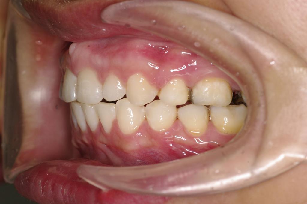 前歯、出っ歯・開咬の矯正治療後口内写真NO.1109